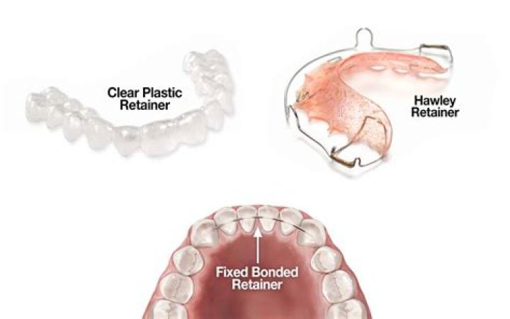 How long do fixed retainers last?